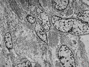 M,50y. | fibrous tumor - pleura